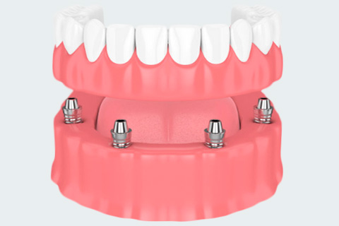 Implantes Dentales All on Four