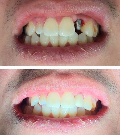 Implante dental Caso Clínico Real Implante dental Caso Clínico Real