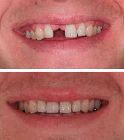 Implantes Dentales - Ejemplo Implantes Dentales - Ejemplo