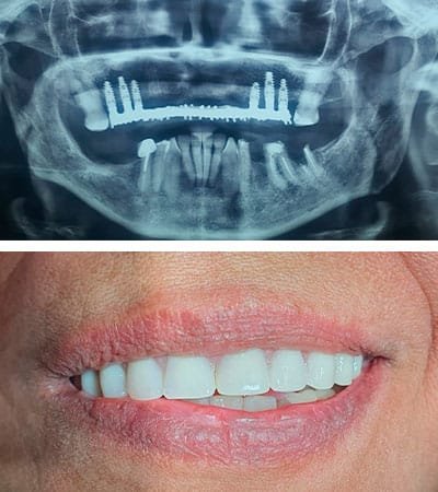 Implantes Dentales - Caso Clínico 20
