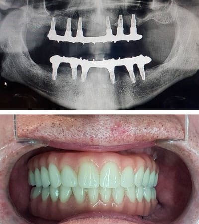 Prótesis Sobre Implantes Dentales Prótesis Sobre Implantes Dentales